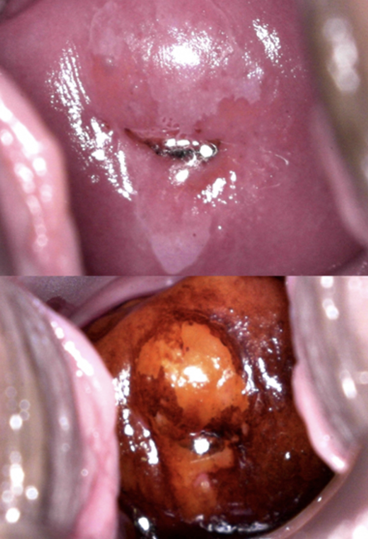 Biópsia de colo uterino ou vagina