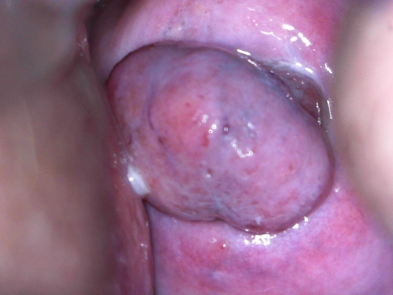 Exérese de pólipo endocervical