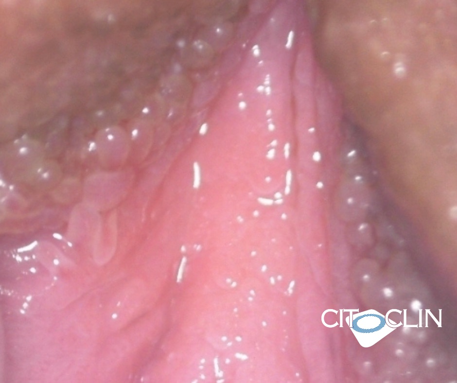 Biópsia de vulva