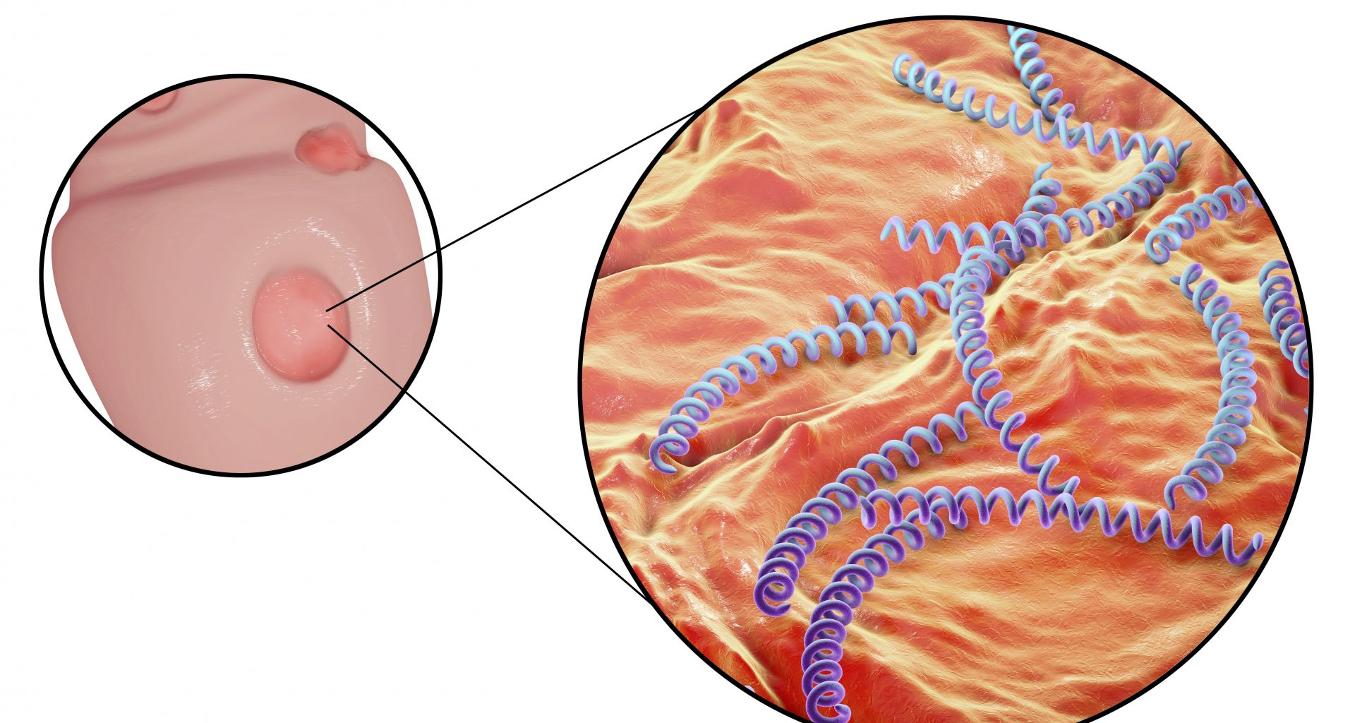 PAINEL/ PCR ÚLCERA GENITAL