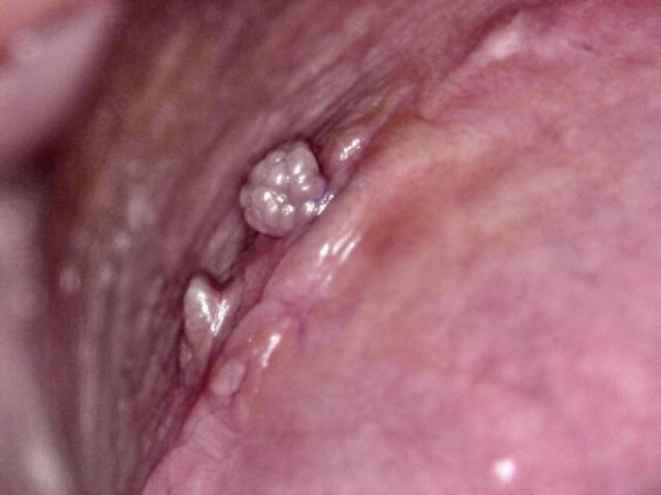 Imagem de Biópsia de pênis