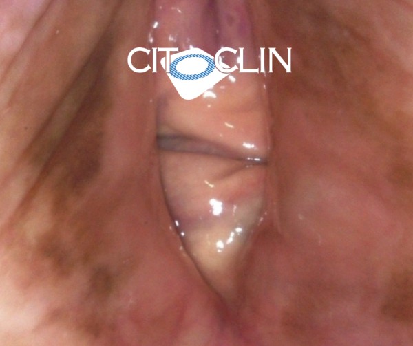 Imagem do procedimento Vulvoscopia ( vídeovulvoscopia)