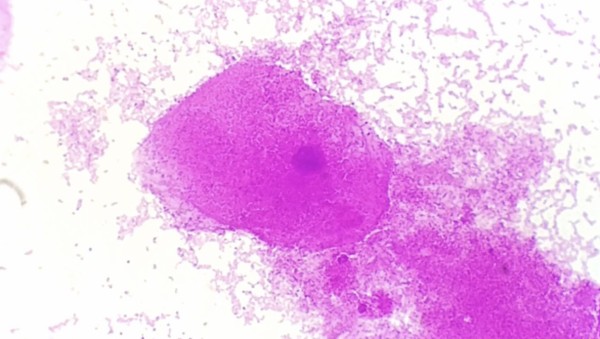 Imagem do procedimento Gram ( Bacterioscópico)