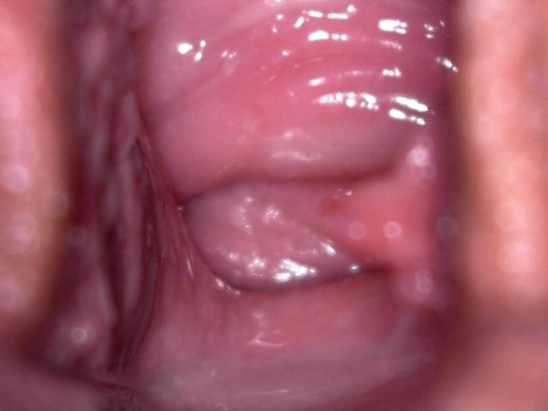 Imagem de Vaginoscopia ( videovaginoscopia)