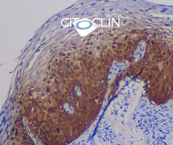 Imagem do procedimento Imunohistoquímica painel ou reagente isolado