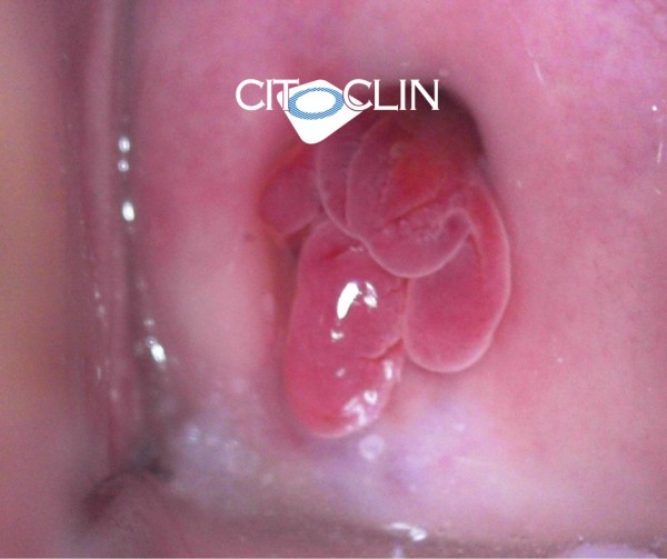 Imagem do procedimento Exérese de pólipo endocervical