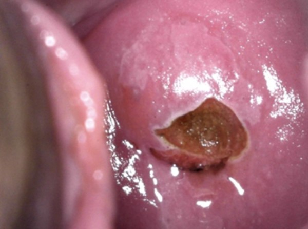 Imagem do procedimento Biópsia de colo uterino ou vagina