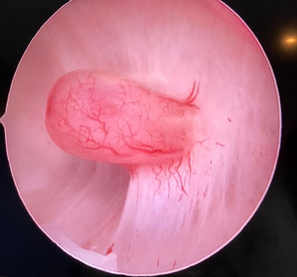 Imagem de Histeroscopia ambulatorial diagnóstica